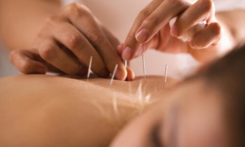 Natural and Alternative Therapy; Woman Having Acupuncture Treatment